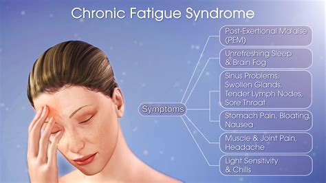 chronic fatigue syndrome chronic fatigue syndrome Kindle Editon
