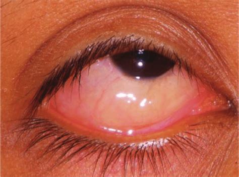 clinical studies diseases eye conjunctiva Epub