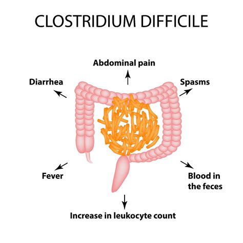 clostridium difficile colitis icd 10