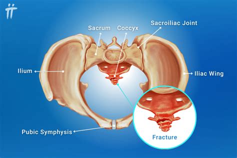 coccyx pain when pregnant