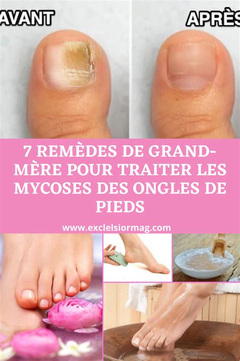 comment pris mycose ongles pieds ebook PDF