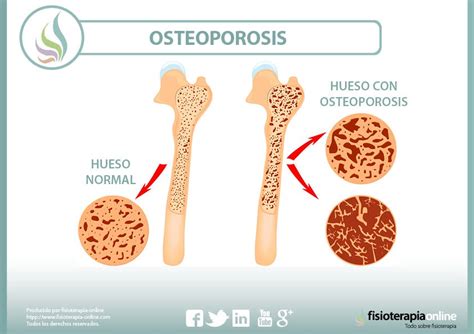 comprender la osteoporosis comprender la osteoporosis Kindle Editon