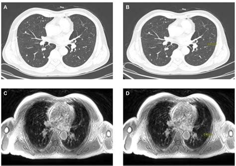 computed tomography and magnetic resonance of the thorax Doc