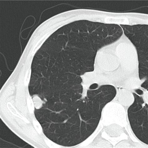 computed tomography of the lung computed tomography of the lung Reader