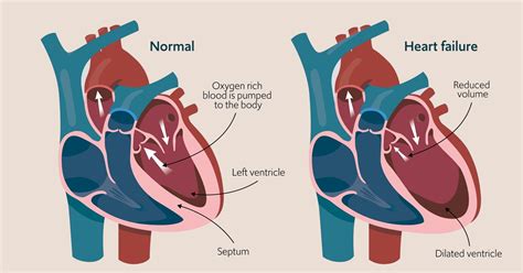 congestive heart failure life expectancy stage 4