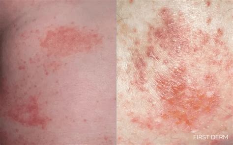 contact dermatitis contact dermatitis Reader