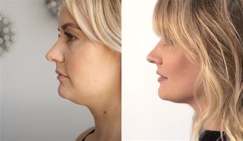 coolsculpting chin before and after