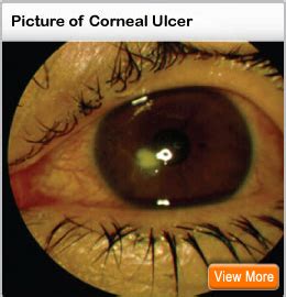 corneal ulcer healing time