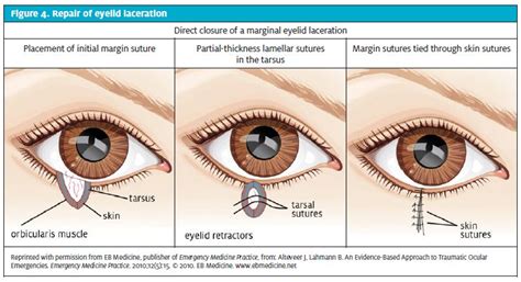 cpt code for laceration repair of eyebrow Reader