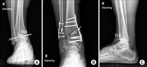 cpt code for supramalleolar osteotomy Kindle Editon