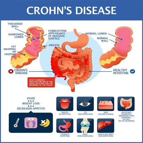 crohns disease diseases and disorders Doc
