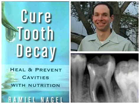 cure tooth decay ramiel nagel Reader