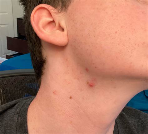 cystic zits on jawline