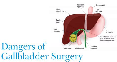 dangers of gallbladder removal PDF