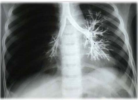 de bronchografie met dionosil la bronchographie au dionosil PDF