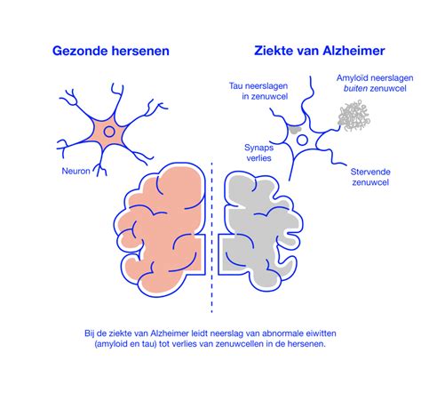 de ziekte van alzheimer oorzaken symptomen onderzoek en behandeling Doc