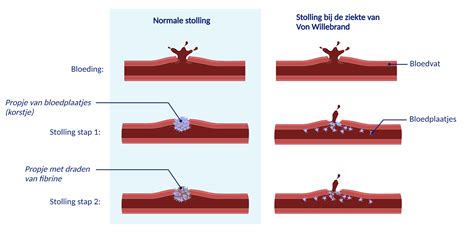 de ziekte van boillaud Reader