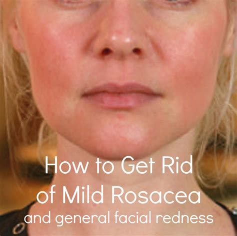 decrease skin redness