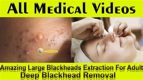 deep blackhead removal