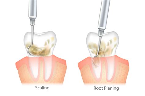 deep scaling and root planing treatment illustration