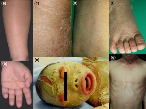 definition lamellar ichthyosis and x linked ichthyosis Reader