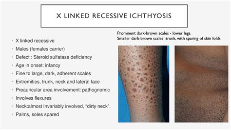 definition lamellar ichthyosis and x linked ichthyosis Reader