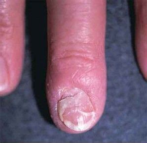 deformed fingernail manual guide Epub
