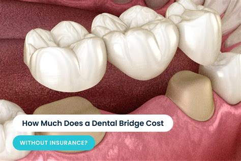 dental bridge cost without insurance