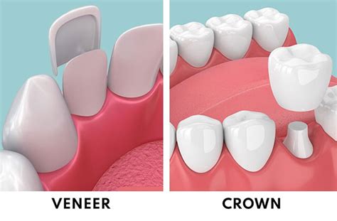 dental crown vs veneer coverage diagram