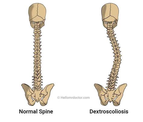 dextrocurvature of lumbar spine