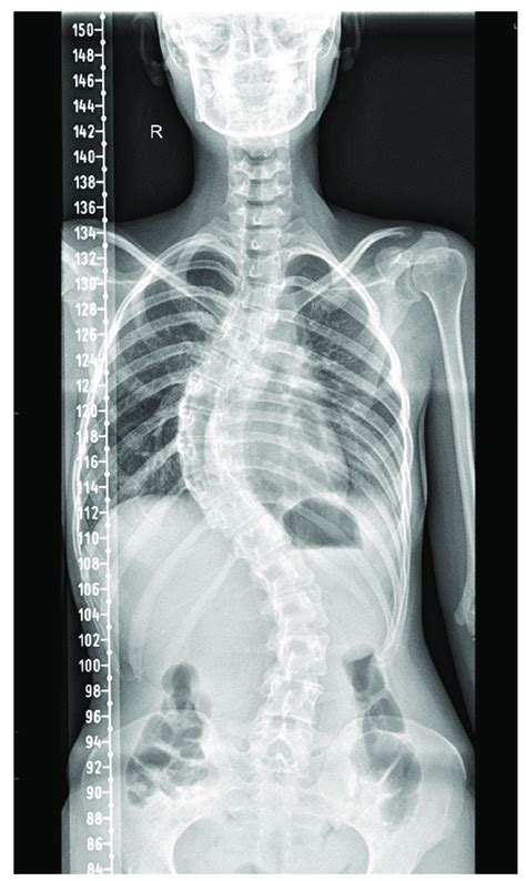 dextroscoliosis of the thoracic spine