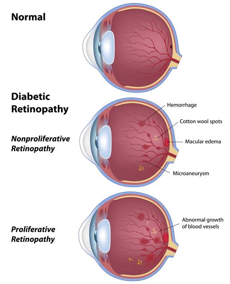 diabetic retinopathy diabetic retinopathy Epub