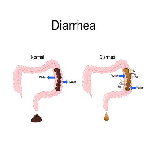 diarrhea all the time