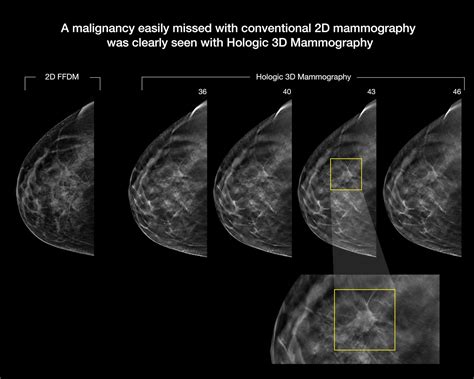 digital breast tomosynthesis technique cases Epub