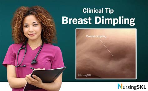 dimpling of breast