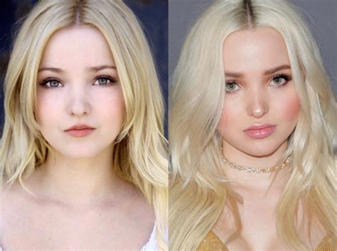 dove cameron face surgery