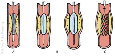 een dotter of stentbehandeling Reader