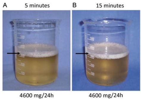 elevated protein in urine