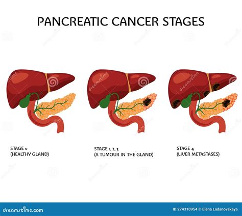 end stage pancreatic cancer