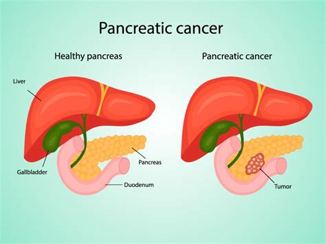 end stage pancreatic cancer timeline