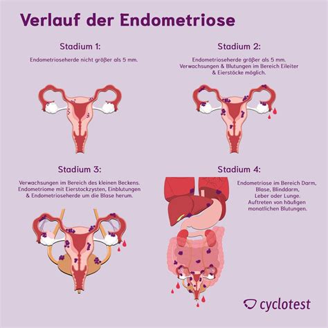endometriose hilfe betroffene angehige german Reader