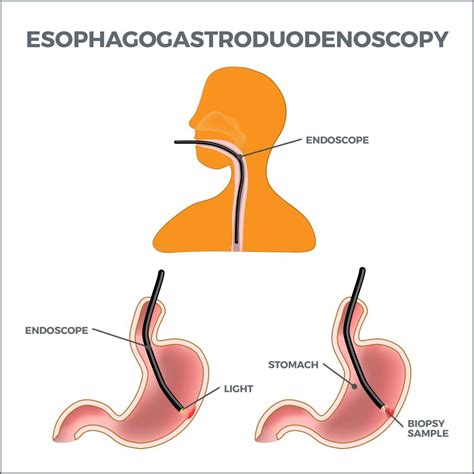 endoscopy of the upper gi tract endoscopy of the upper gi tract PDF