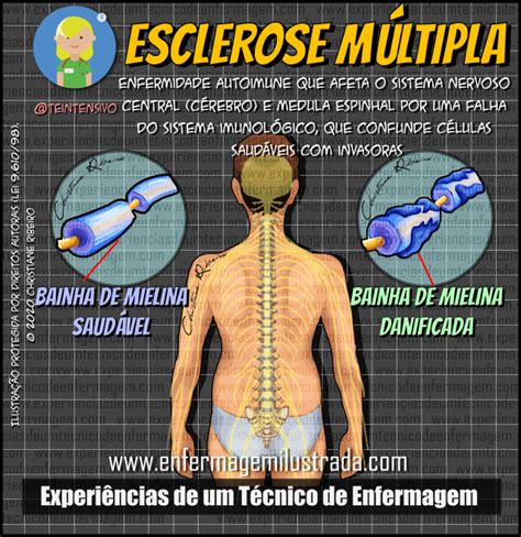 esclerose múltipla cuidados de enfermagem