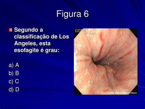 esofagite erosiva distal grau b de los angeles