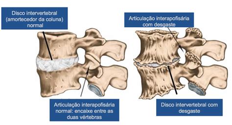 espondiloartrose