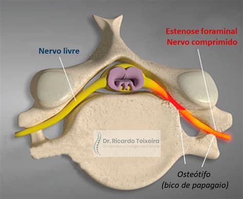 estenose foraminal