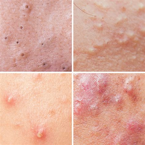 everything you need to know about acne need to know library Doc