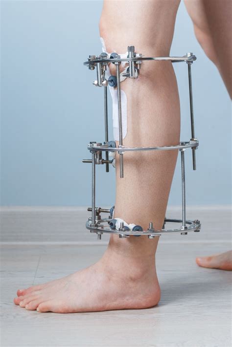 external fixators of the foot and ankle Doc