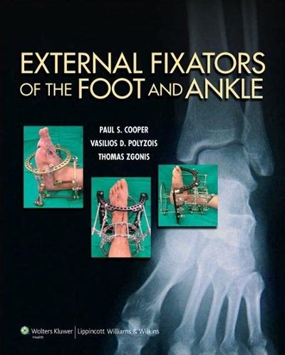 external fixators of the foot and ankle Doc