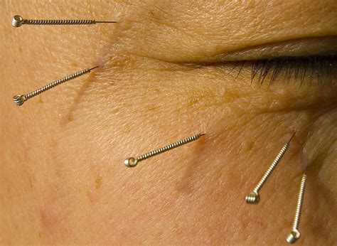 eye acupuncture therapy Epub